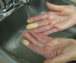 Hiện tượng Raynaud - Hình ảnh minh họa